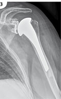 Röntgenbild Schulterprothese